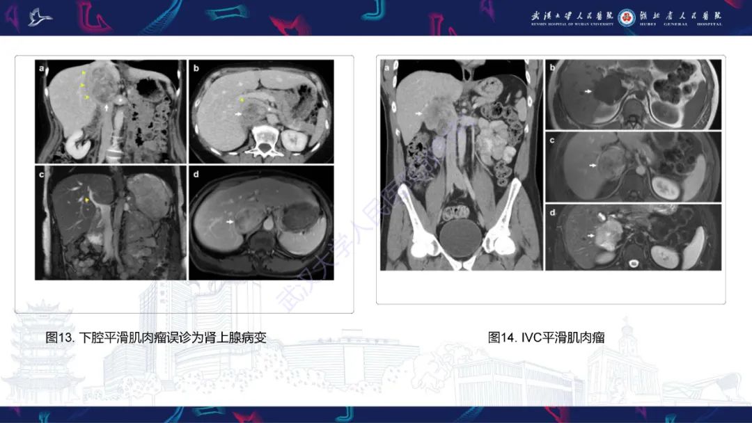 【PPT】下腔静脉解剖变异及病变影像诊断-18
