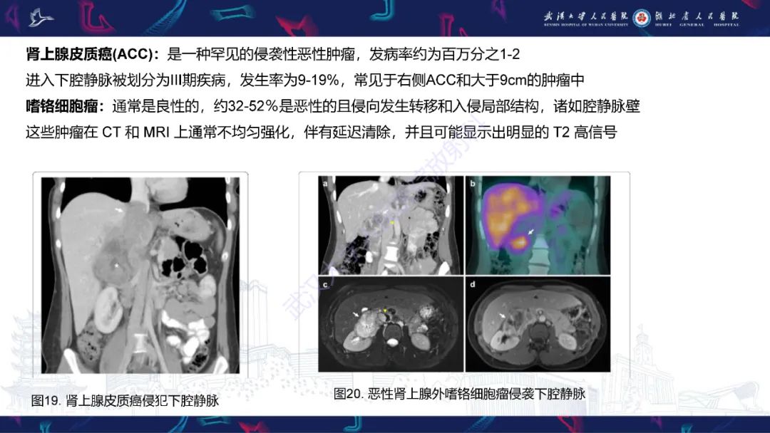 【PPT】下腔静脉解剖变异及病变影像诊断-22