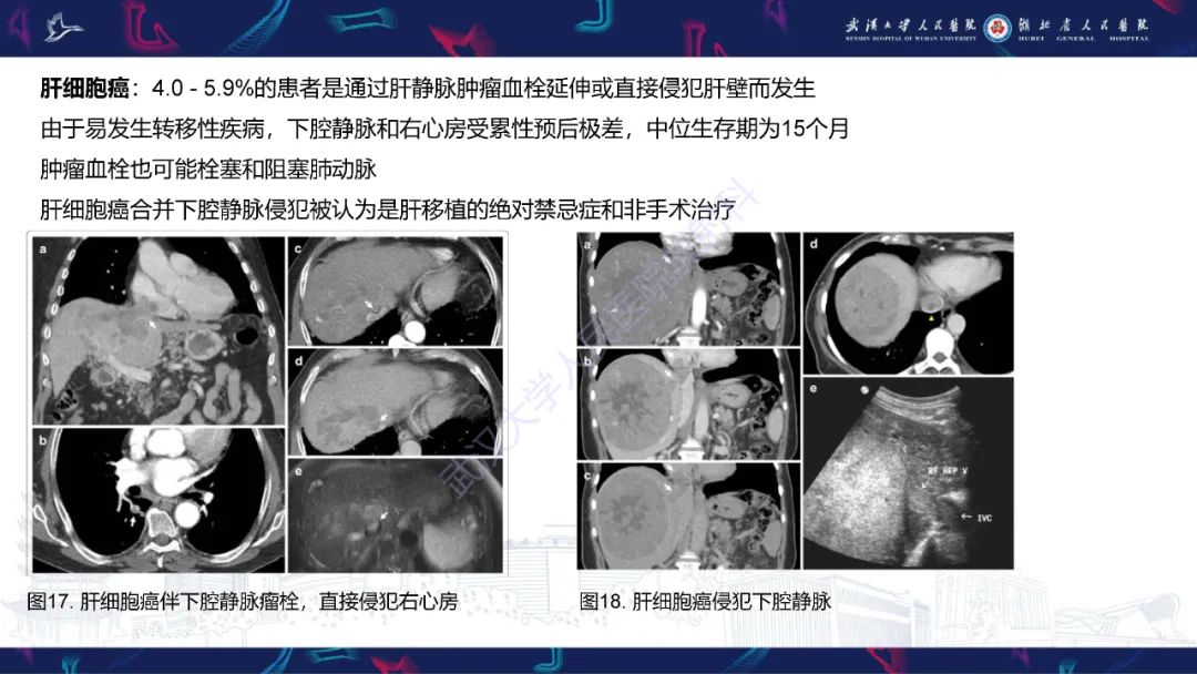 【PPT】下腔静脉解剖变异及病变影像诊断-21