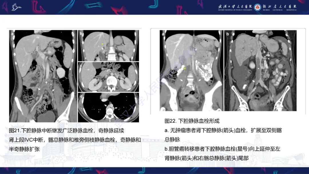 【PPT】下腔静脉解剖变异及病变影像诊断-24