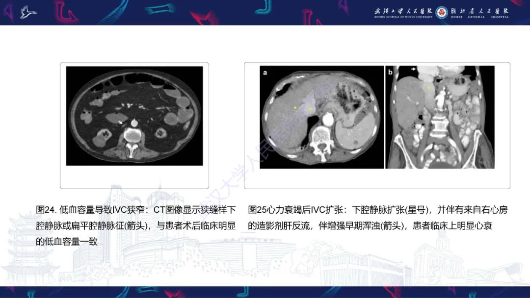 【PPT】下腔静脉解剖变异及病变影像诊断-26
