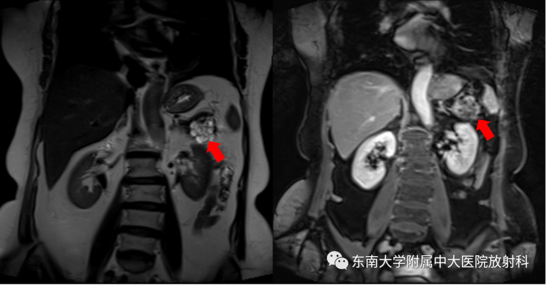 【PPT】胰腺常见囊性病变影像表现-3