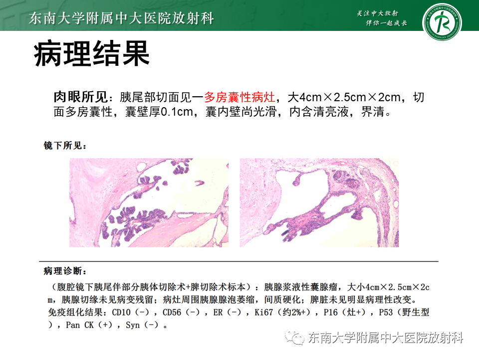 【PPT】胰腺常见囊性病变影像表现-4