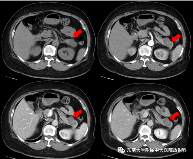 【PPT】胰腺常见囊性病变影像表现-1