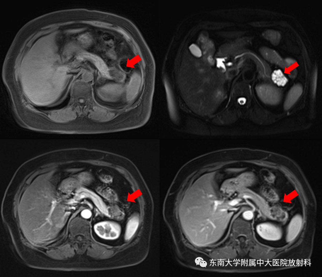 【PPT】胰腺常见囊性病变影像表现-2