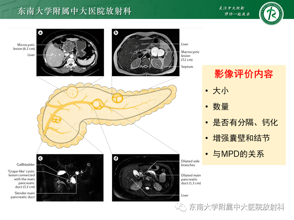 【PPT】胰腺常见囊性病变影像表现-11