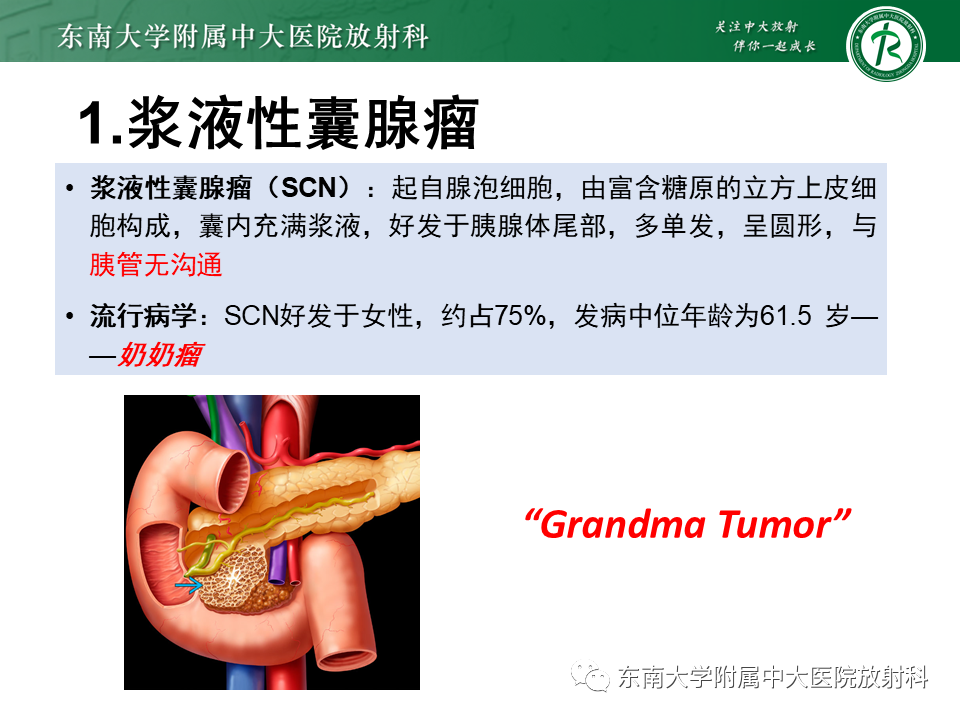 【PPT】胰腺常见囊性病变影像表现-17