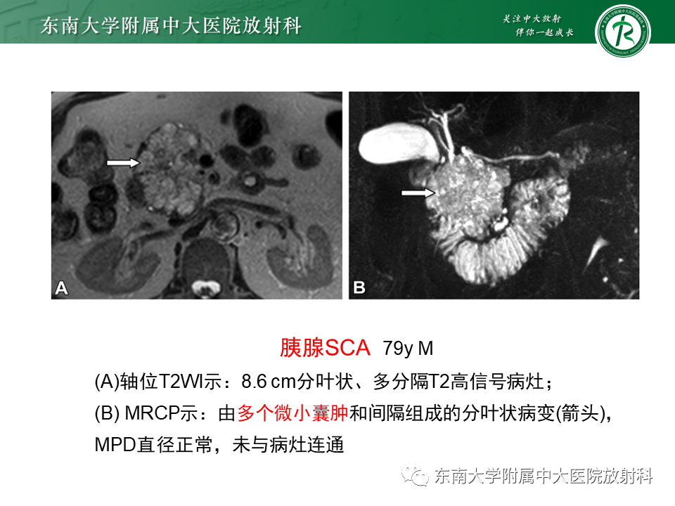 【PPT】胰腺常见囊性病变影像表现-19