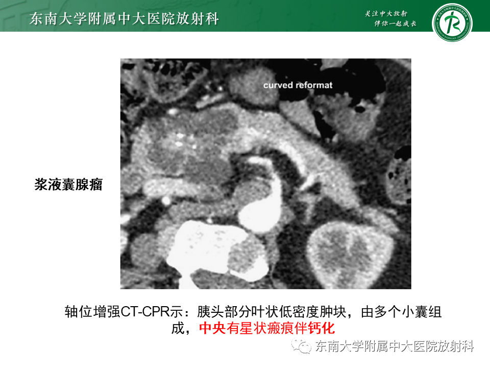 【PPT】胰腺常见囊性病变影像表现-20