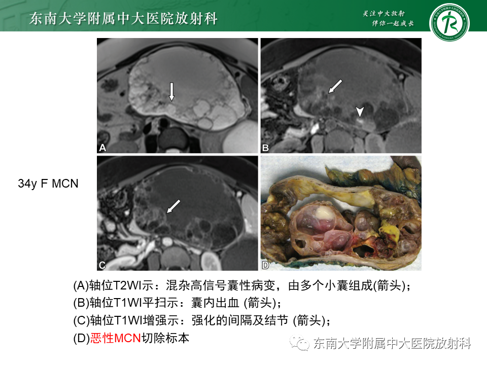 【PPT】胰腺常见囊性病变影像表现-24