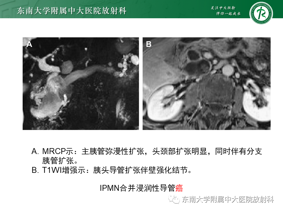 【PPT】胰腺常见囊性病变影像表现-28