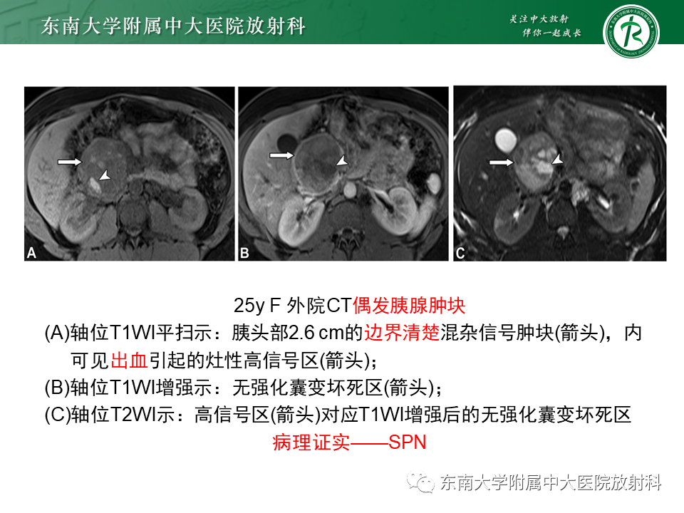【PPT】胰腺常见囊性病变影像表现-32