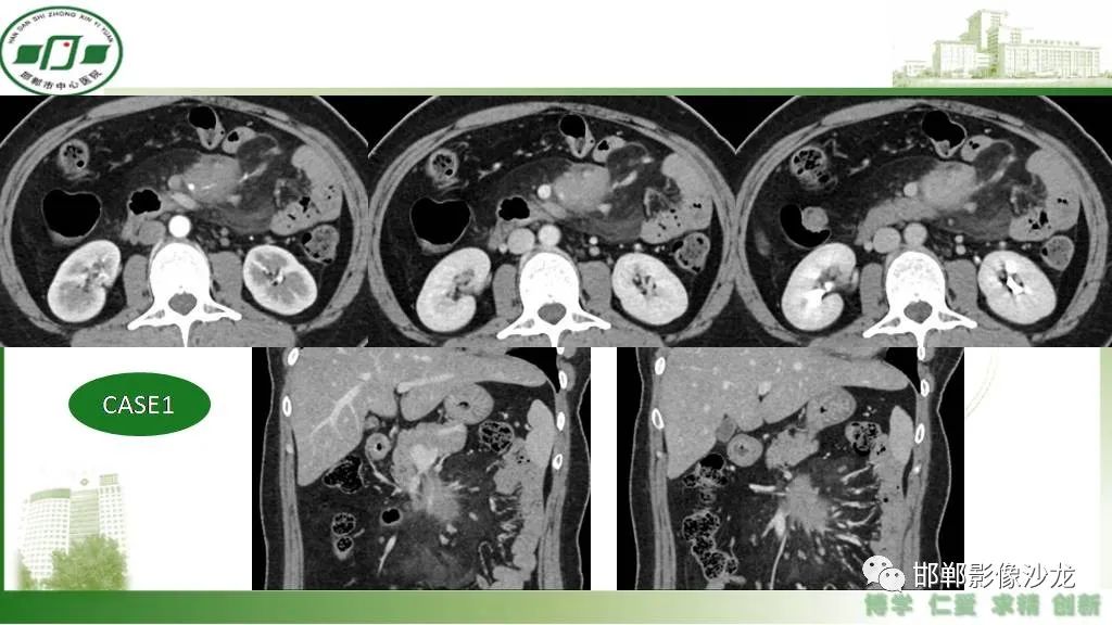 【PPT】硬化性肠系膜炎-2