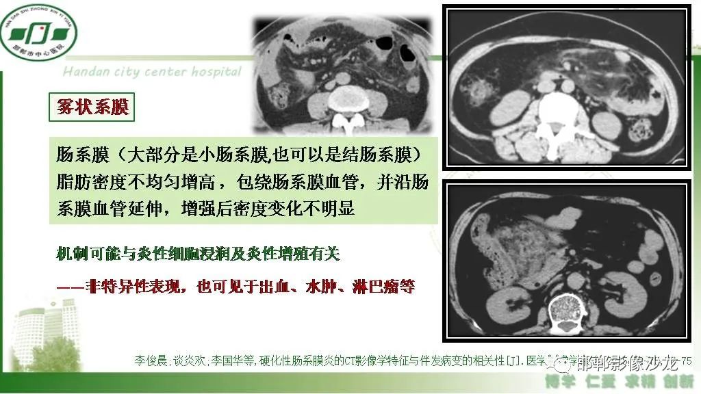 【PPT】硬化性肠系膜炎-12