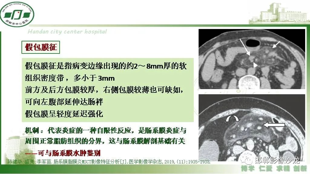 【PPT】硬化性肠系膜炎-14
