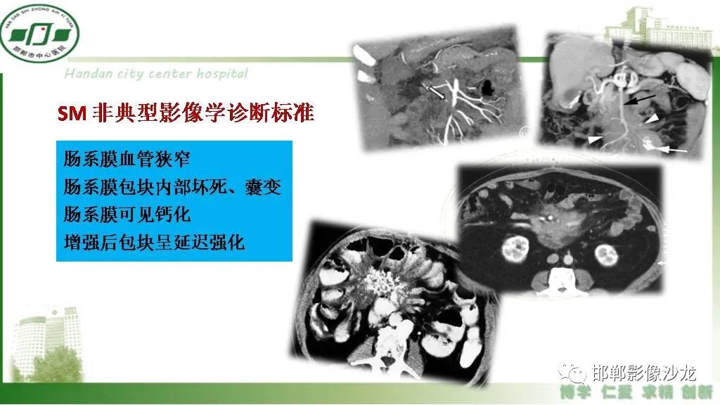 【PPT】硬化性肠系膜炎-16