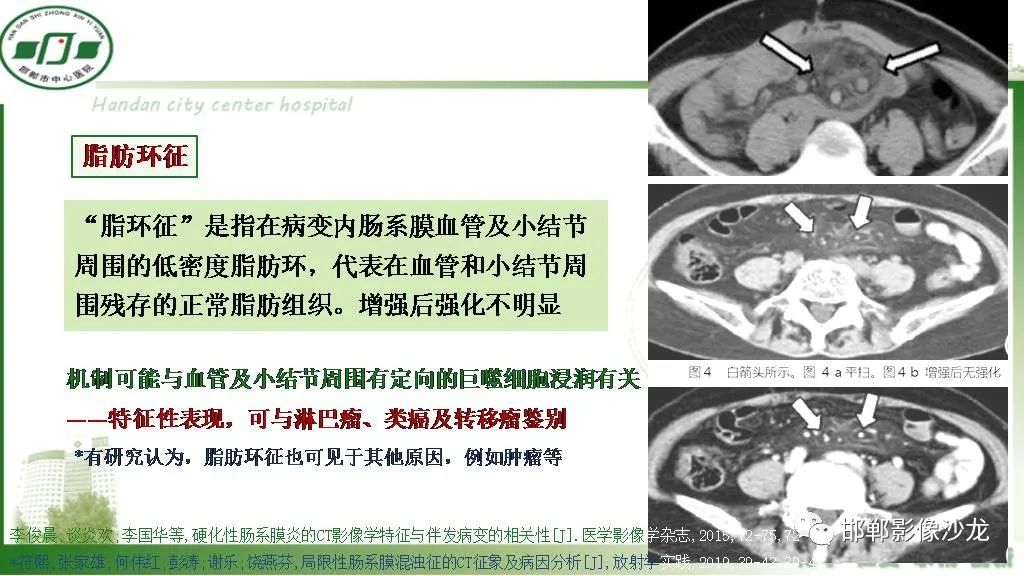 【PPT】硬化性肠系膜炎-13