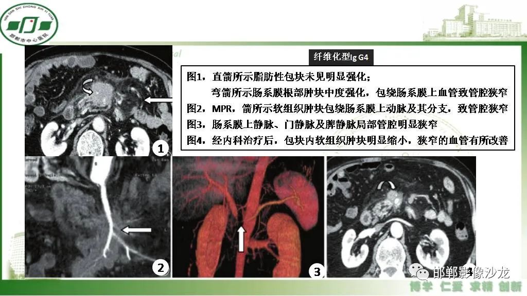 【PPT】硬化性肠系膜炎-18