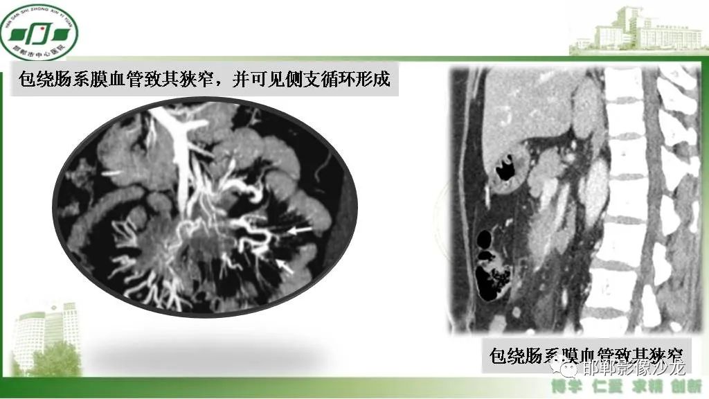 【PPT】硬化性肠系膜炎-19
