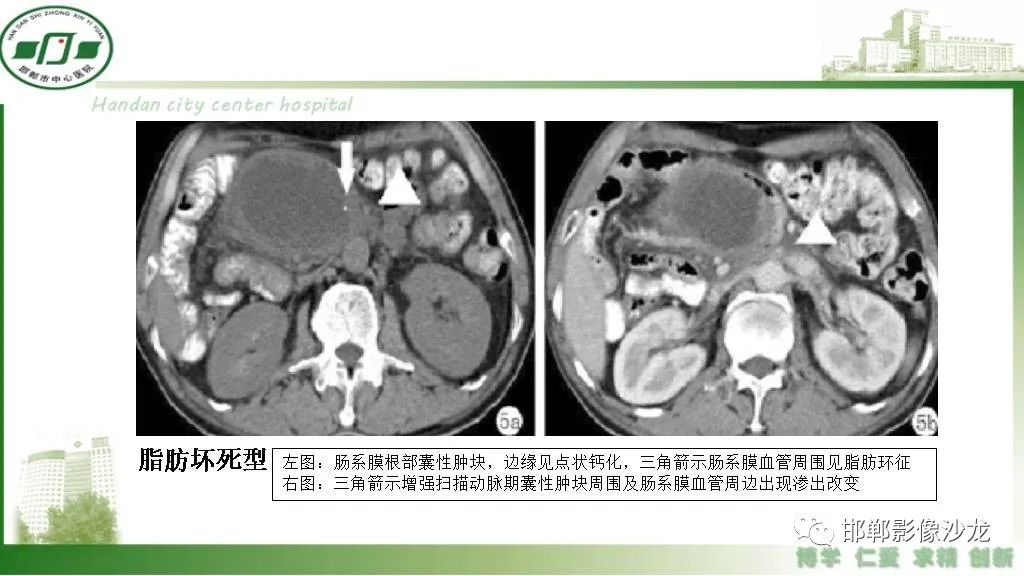 【PPT】硬化性肠系膜炎-21