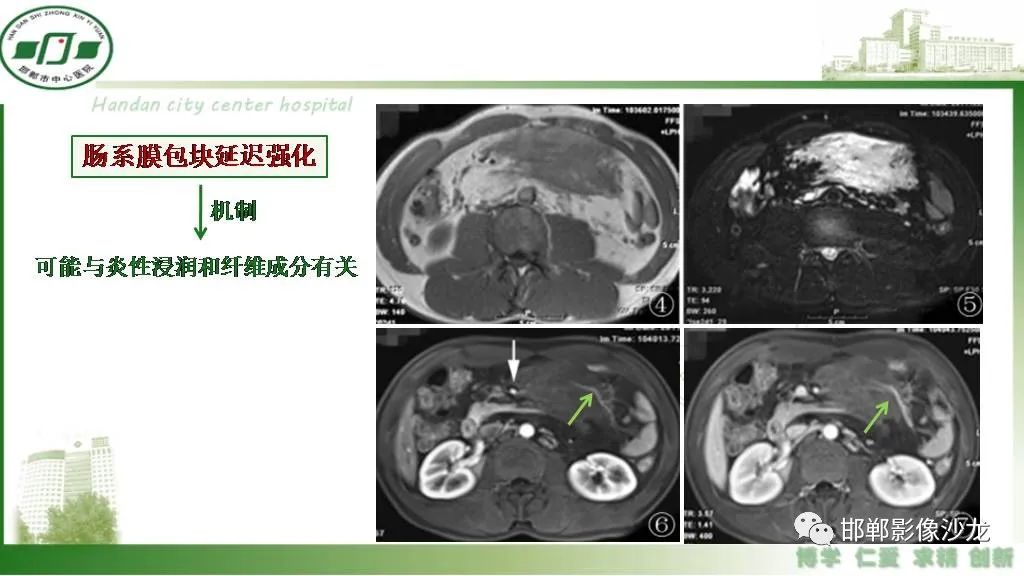 【PPT】硬化性肠系膜炎-22