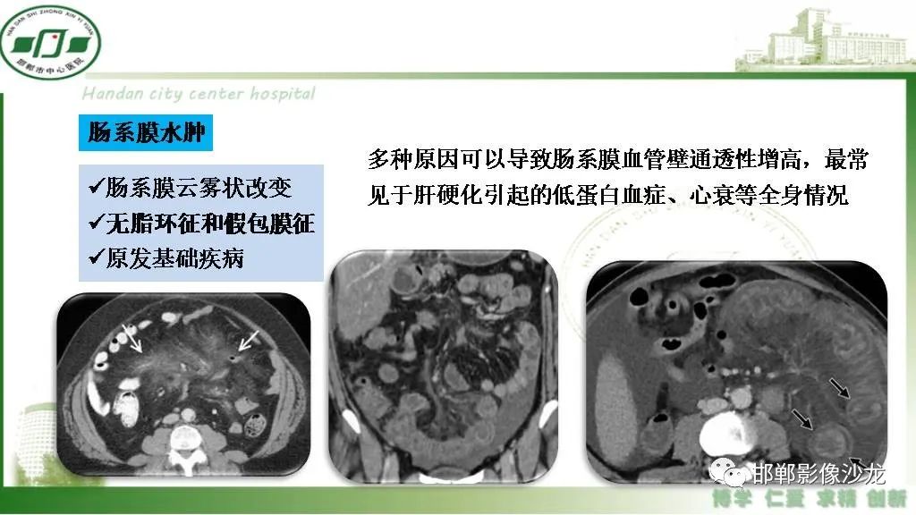 【PPT】硬化性肠系膜炎-24