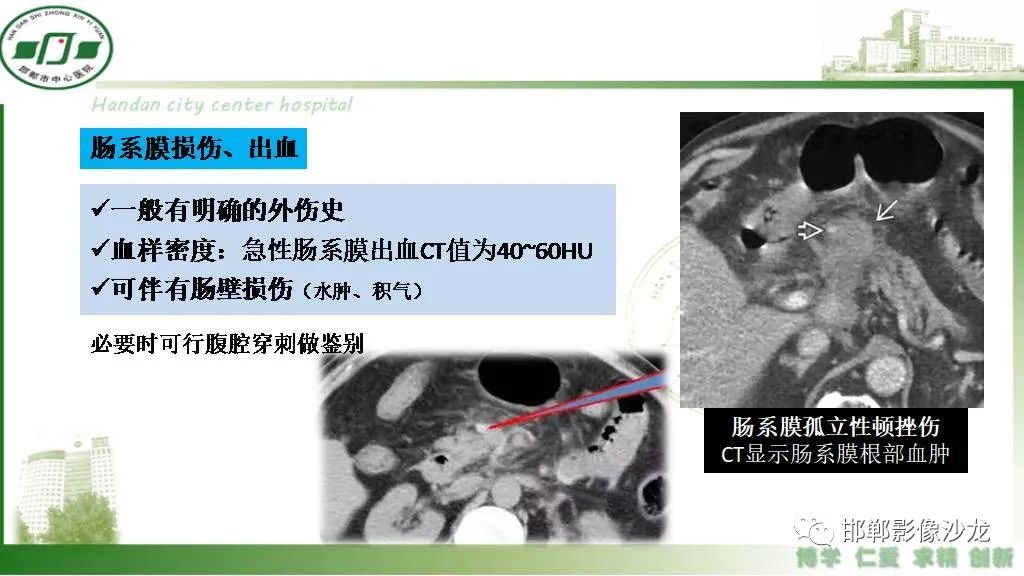 【PPT】硬化性肠系膜炎-25