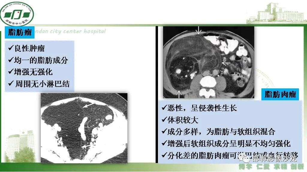 【PPT】硬化性肠系膜炎-27