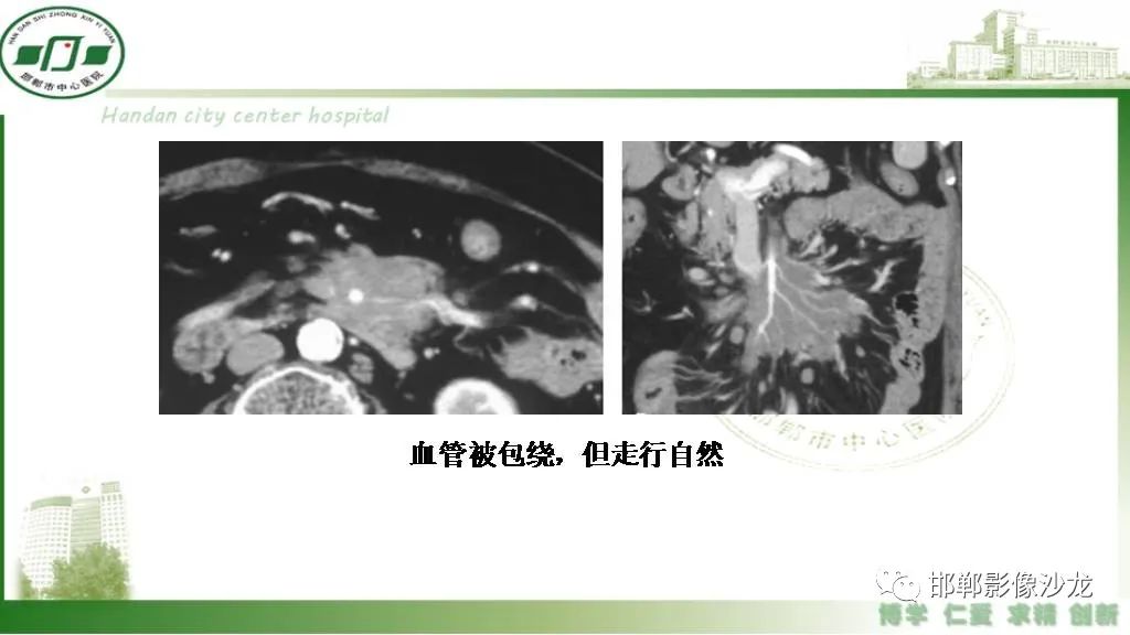 【PPT】硬化性肠系膜炎-29