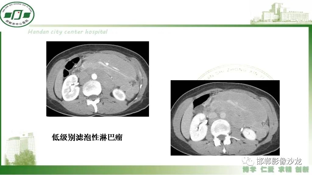 【PPT】硬化性肠系膜炎-30