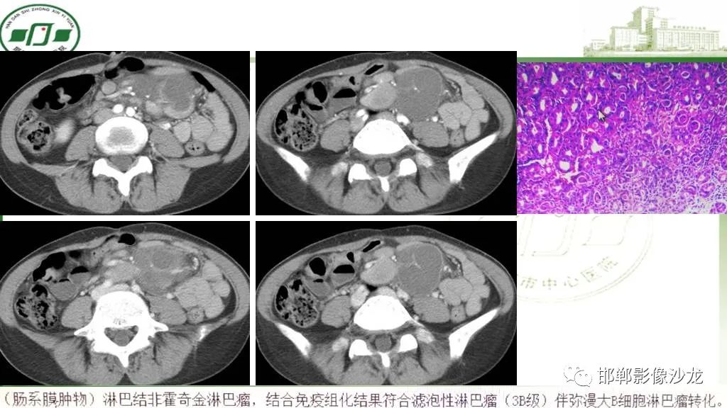 【PPT】硬化性肠系膜炎-31