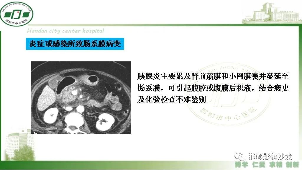 【PPT】硬化性肠系膜炎-35