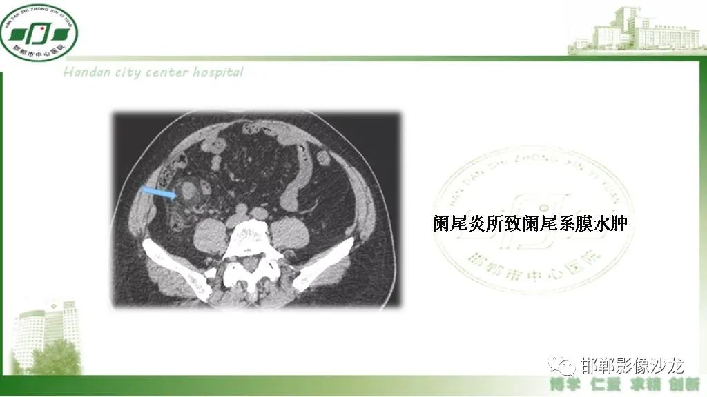 【PPT】硬化性肠系膜炎-36