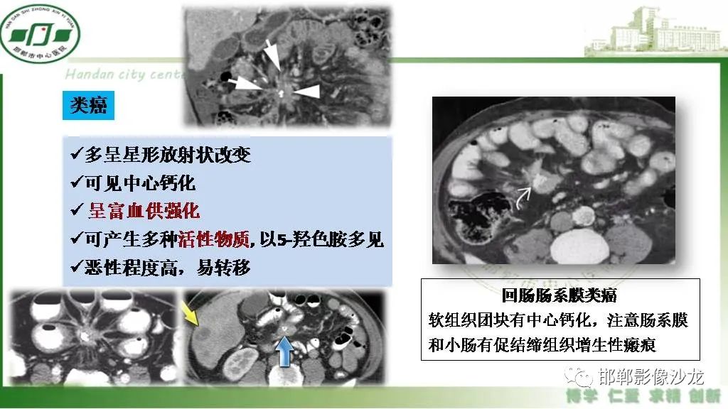 【PPT】硬化性肠系膜炎-32