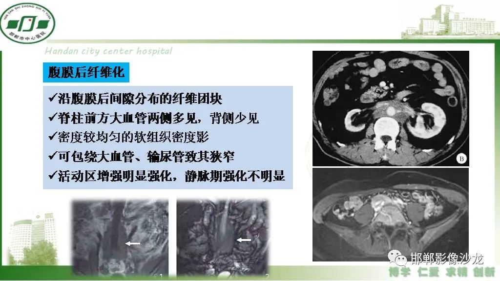 【PPT】硬化性肠系膜炎-34