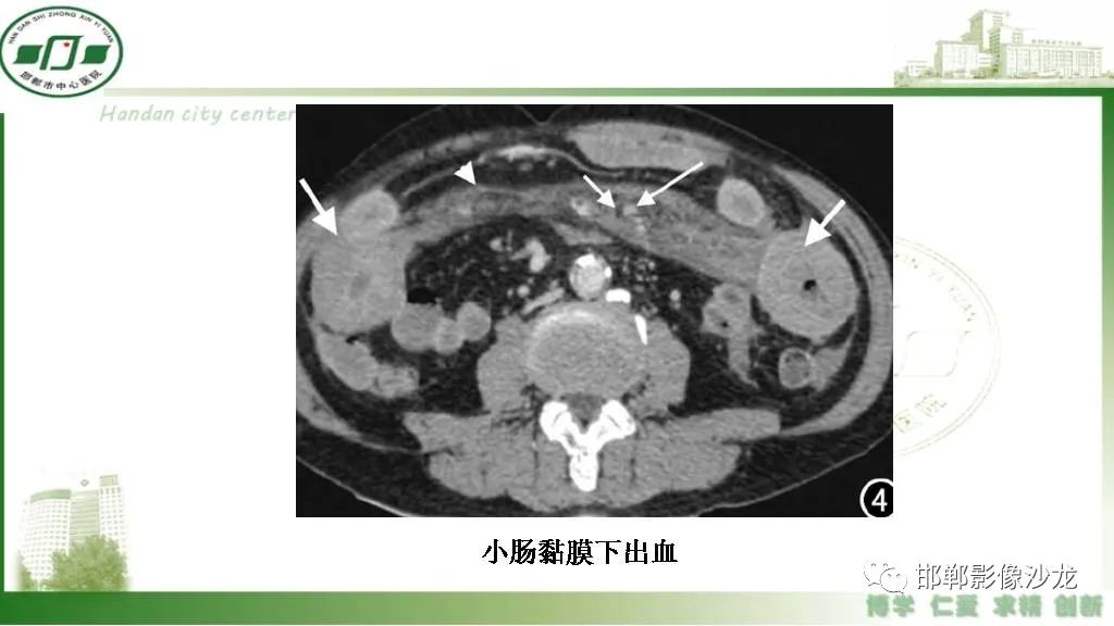 【PPT】硬化性肠系膜炎-38