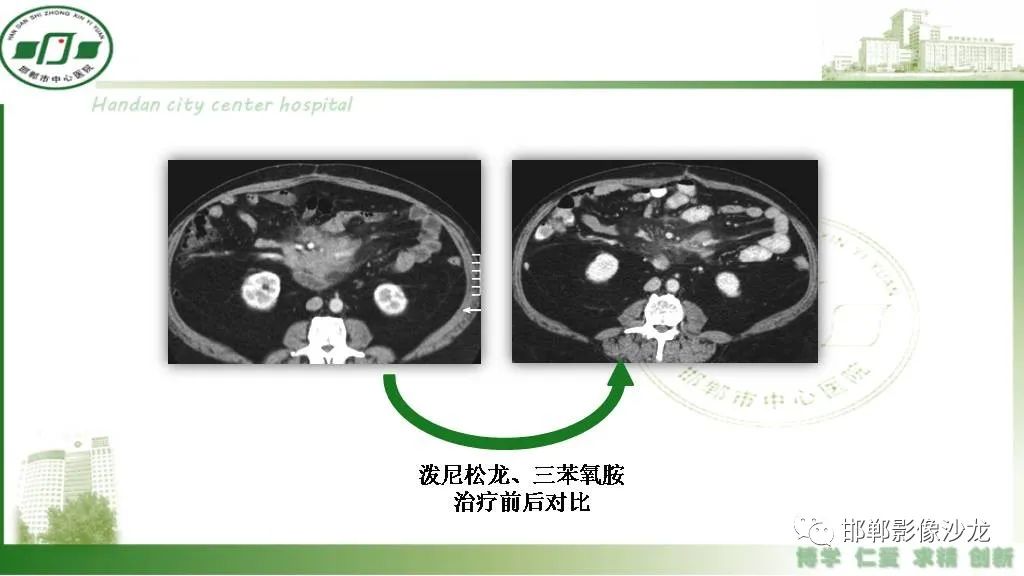 【PPT】硬化性肠系膜炎-40