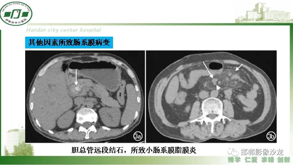 【PPT】硬化性肠系膜炎-37