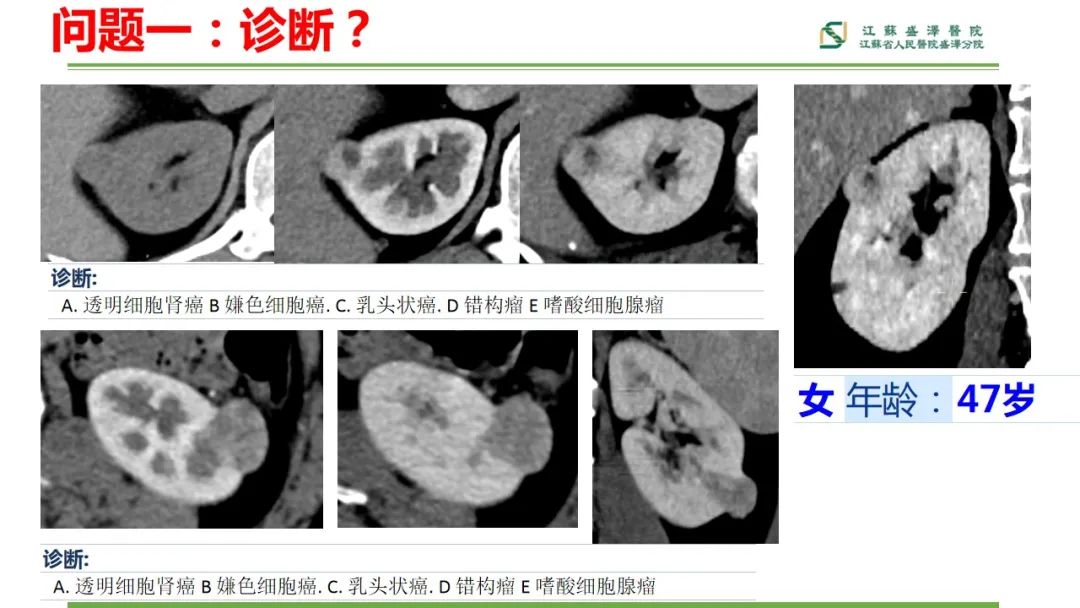 【PPT】肾脏实性肿瘤的良恶性鉴别--影像诊断思路分析-3