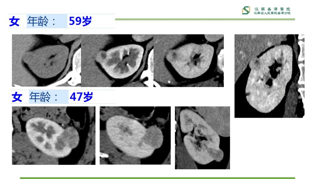 【PPT】肾脏实性肿瘤的良恶性鉴别--影像诊断思路分析-2