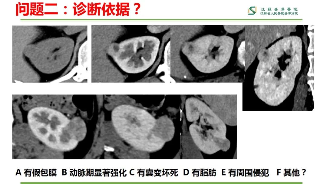 【PPT】肾脏实性肿瘤的良恶性鉴别--影像诊断思路分析-4