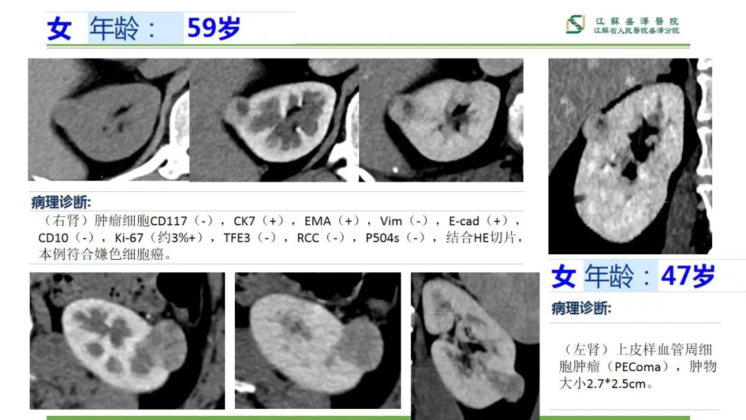 【PPT】肾脏实性肿瘤的良恶性鉴别--影像诊断思路分析-5