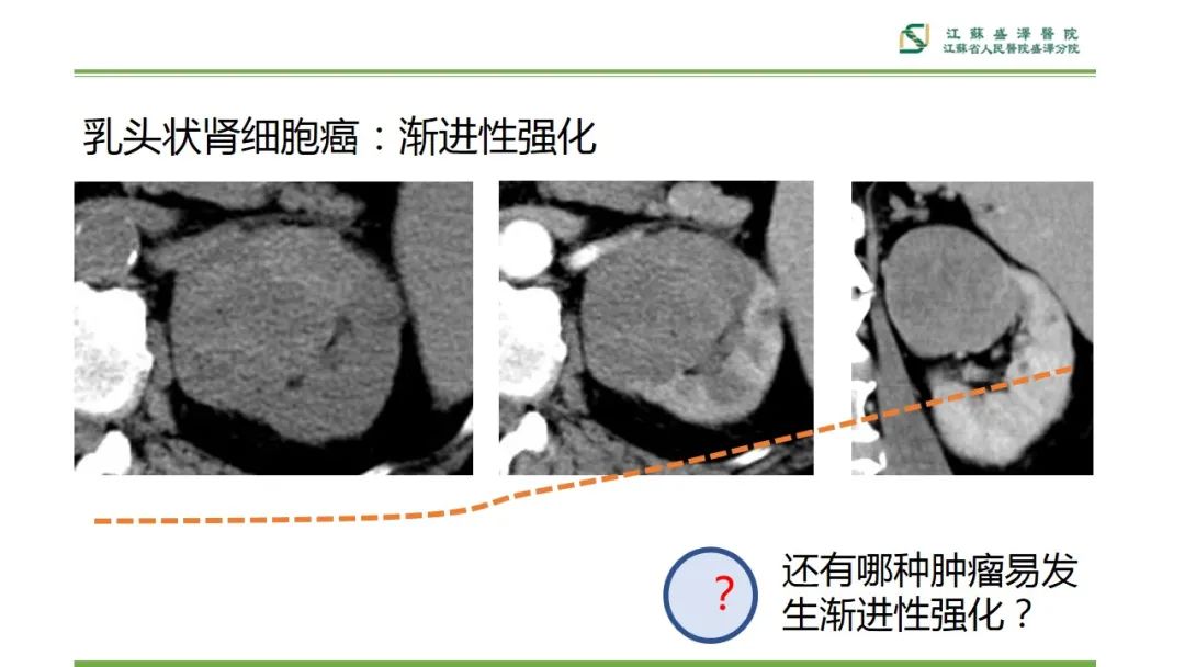 【PPT】肾脏实性肿瘤的良恶性鉴别--影像诊断思路分析-12