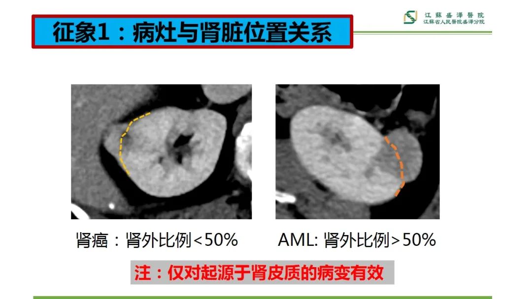 【PPT】肾脏实性肿瘤的良恶性鉴别--影像诊断思路分析-8