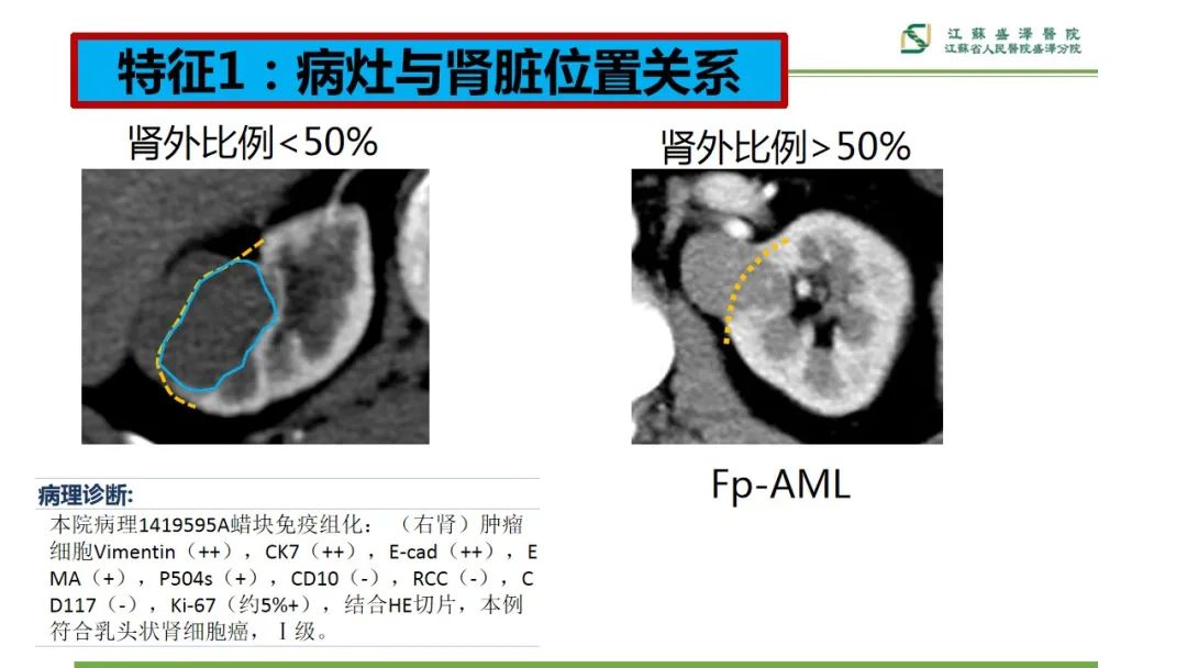 【PPT】肾脏实性肿瘤的良恶性鉴别--影像诊断思路分析-9