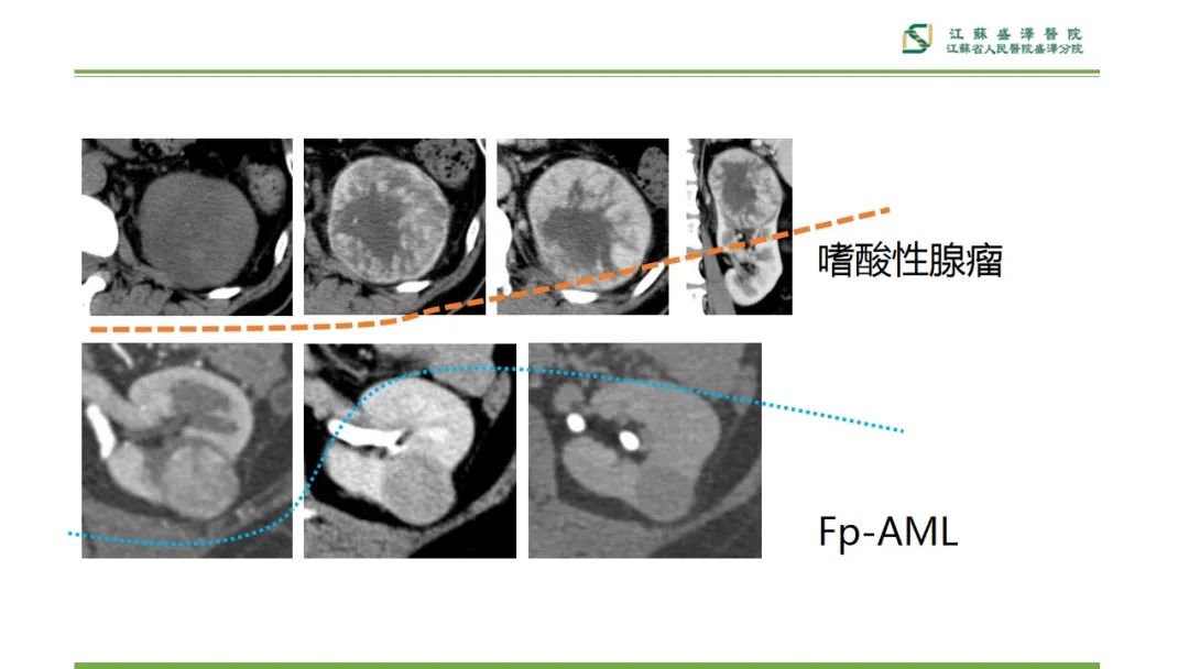 【PPT】肾脏实性肿瘤的良恶性鉴别--影像诊断思路分析-13