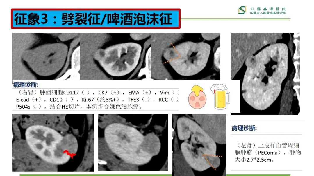【PPT】肾脏实性肿瘤的良恶性鉴别--影像诊断思路分析-15