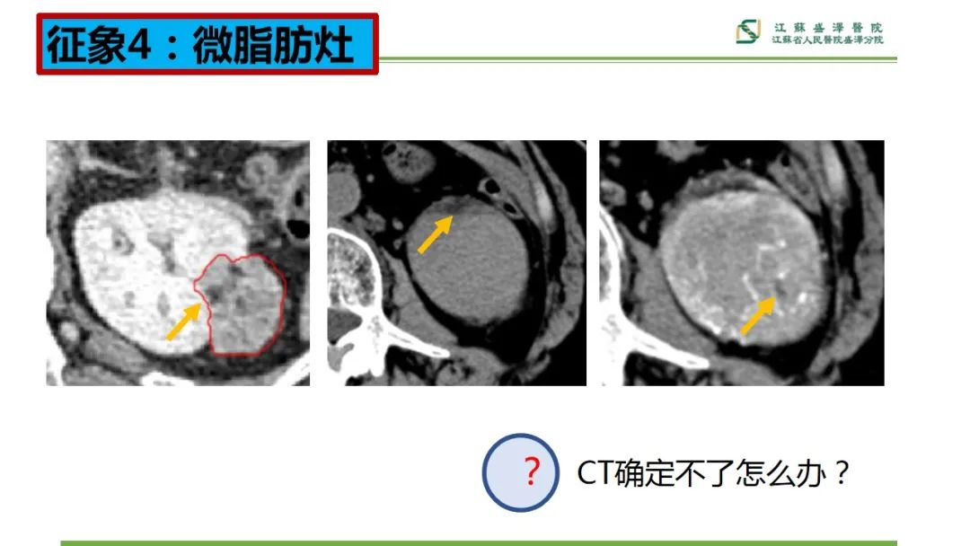 【PPT】肾脏实性肿瘤的良恶性鉴别--影像诊断思路分析-17