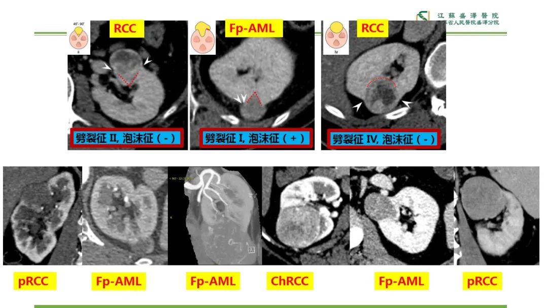 【PPT】肾脏实性肿瘤的良恶性鉴别--影像诊断思路分析-16