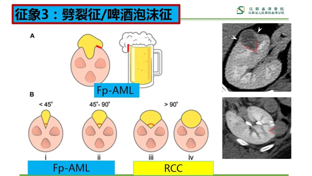 【PPT】肾脏实性肿瘤的良恶性鉴别--影像诊断思路分析-14